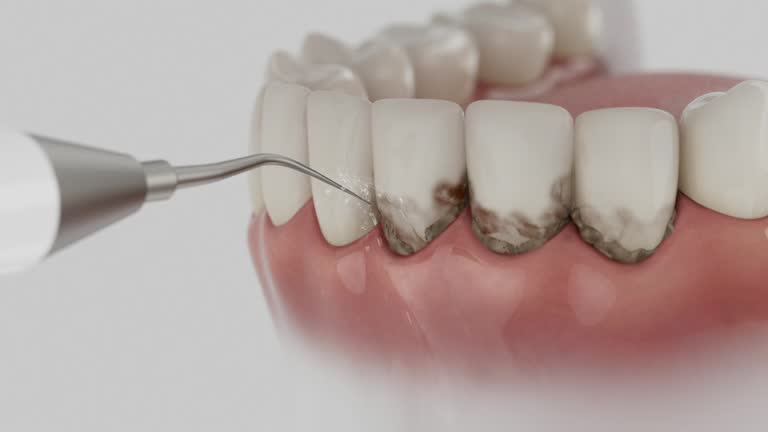 Trusted Wisdom Tooth Removal service in Cudahy, WI - Dentist Open Now